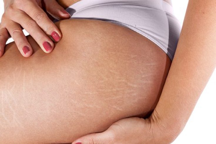 Как убрать растяжки на теле: эффективные способы для гладкости кожи